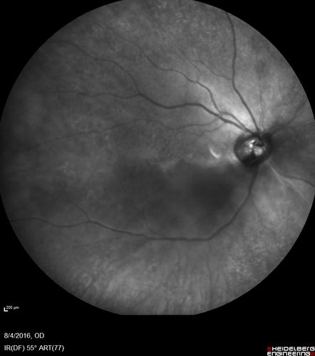 Branch Retinal Artery Occlusion
Acute Inferotemporal Occlusion Right Eye - FA shows delayed circulation, OCT shows edema of superficial layers of retina
