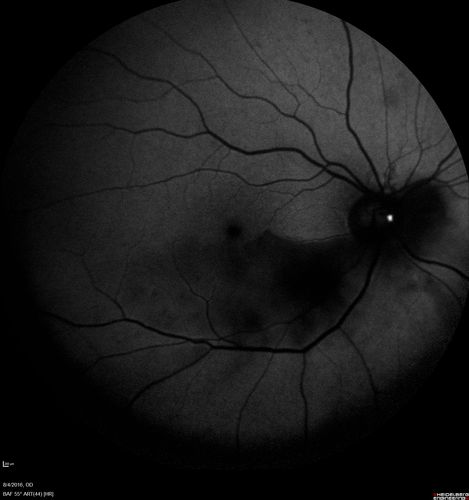 Branch Retinal Artery Occlusion
Acute Inferotemporal Occlusion Right Eye - FA shows delayed circulation, OCT shows edema of superficial layers of retina
