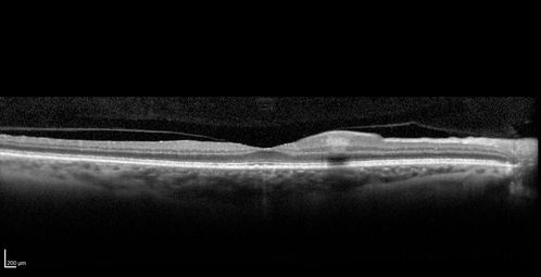Branch Retinal Artery Occlusion
Acute Inferotemporal Occlusion Right Eye - FA shows delayed circulation, OCT shows edema of superficial layers of retina
