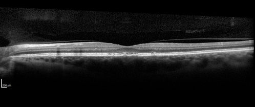 Branch Retinal Artery Occlusion
Acute Inferotemporal Occlusion Right Eye - FA shows delayed circulation, OCT shows edema of superficial layers of retina

