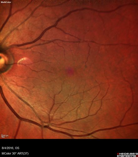 Branch Retinal Artery Occlusion
Acute Inferotemporal Occlusion Right Eye - FA shows delayed circulation, OCT shows edema of superficial layers of retina
