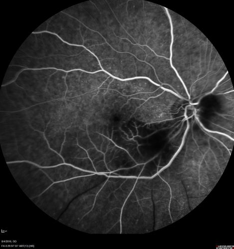 Branch Retinal Artery Occlusion
Acute Inferotemporal Occlusion Right Eye - FA shows delayed circulation, OCT shows edema of superficial layers of retina
