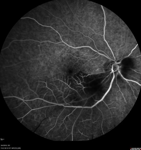 Branch Retinal Artery Occlusion
Acute Inferotemporal Occlusion Right Eye - FA shows delayed circulation, OCT shows edema of superficial layers of retina
