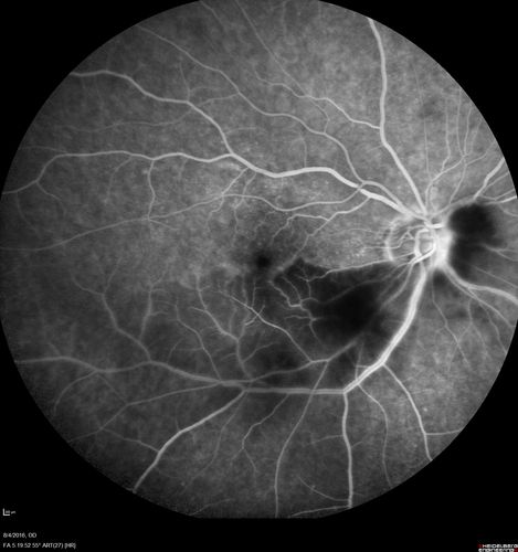 Branch Retinal Artery Occlusion
Acute Inferotemporal Occlusion Right Eye - FA shows delayed circulation, OCT shows edema of superficial layers of retina
