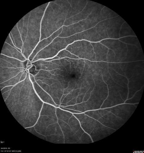 Branch Retinal Artery Occlusion
Acute Inferotemporal Occlusion Right Eye - FA shows delayed circulation, OCT shows edema of superficial layers of retina
