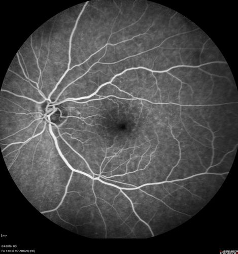 Branch Retinal Artery Occlusion
Acute Inferotemporal Occlusion Right Eye - FA shows delayed circulation, OCT shows edema of superficial layers of retina
