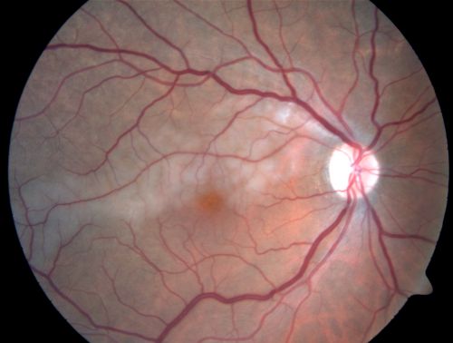Branch Retinal Arterial Occlusion 20/20 Vision - Symptoms for 1 Day
