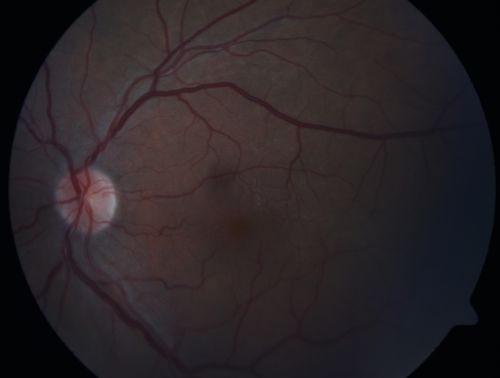 Branch Retinal Arterial Occlusion 20/20 Vision - Symptoms for 1 Day
