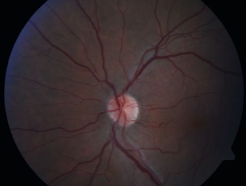 Branch Retinal Arterial Occlusion 20/20 Vision - Symptoms for 1 Day
