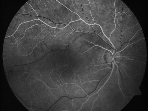 Branch Retinal Arterial Occlusion 20/20 Vision - Symptoms for 1 Day
