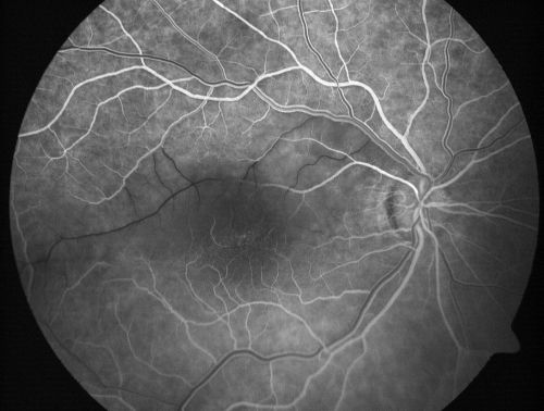 Branch Retinal Arterial Occlusion 20/20 Vision - Symptoms for 1 Day
75-year-old man was seen in the office on 4/6/2010.  He noticed a sudden vision change in the right eye yesterday morning.  20/20 Vision both Eyes

