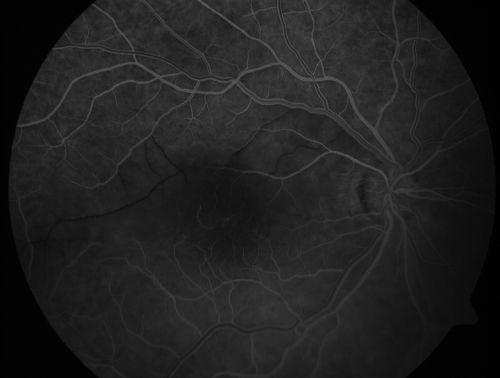 Branch Retinal Arterial Occlusion 20/20 Vision - Symptoms for 1 Day
75-year-old man was seen in the office on 4/6/2010.  He noticed a sudden vision change in the right eye yesterday morning.  20/20 Vision both Eyes


