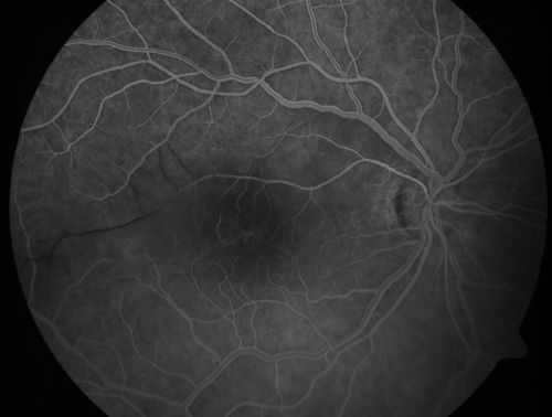 Branch Retinal Arterial Occlusion 20/20 Vision - Symptoms for 1 Day
75-year-old man was seen in the office on 4/6/2010.  He noticed a sudden vision change in the right eye yesterday morning.  20/20 Vision both Eyes

