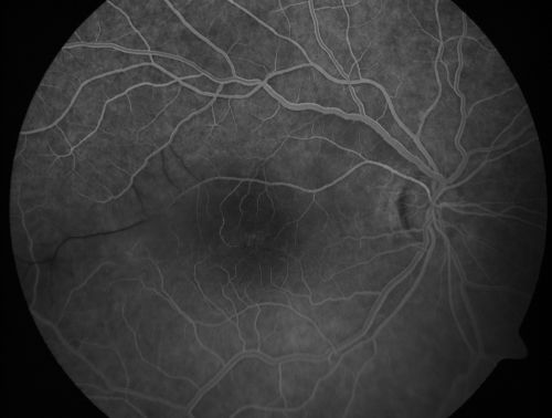 Branch Retinal Arterial Occlusion 20/20 Vision - Symptoms for 1 Day
75-year-old man was seen in the office on 4/6/2010.  He noticed a sudden vision change in the right eye yesterday morning.  20/20 Vision both Eyes

