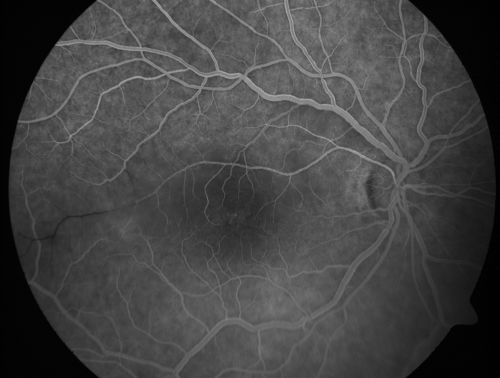 Branch Retinal Arterial Occlusion 20/20 Vision - Symptoms for 1 Day
75-year-old man was seen in the office on 4/6/2010.  He noticed a sudden vision change in the right eye yesterday morning.  20/20 Vision both Eyes

