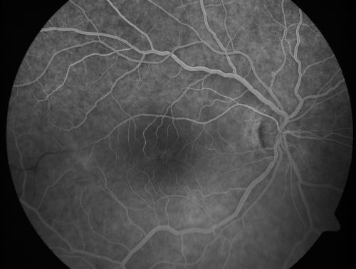 Branch Retinal Arterial Occlusion 20/20 Vision - Symptoms for 1 Day
75-year-old man was seen in the office on 4/6/2010.  He noticed a sudden vision change in the right eye yesterday morning.  20/20 Vision both Eyes

