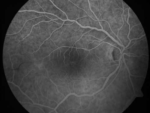 Branch Retinal Arterial Occlusion 20/20 Vision - Symptoms for 1 Day
75-year-old man was seen in the office on 4/6/2010.  He noticed a sudden vision change in the right eye yesterday morning.  20/20 Vision both Eyes

