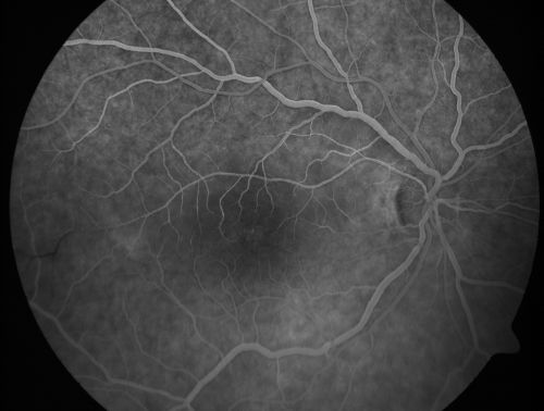 Branch Retinal Arterial Occlusion 20/20 Vision - Symptoms for 1 Day
75-year-old man was seen in the office on 4/6/2010.  He noticed a sudden vision change in the right eye yesterday morning.  20/20 Vision both Eyes

