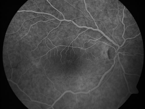 Branch Retinal Arterial Occlusion 20/20 Vision - Symptoms for 1 Day
75-year-old man was seen in the office on 4/6/2010.  He noticed a sudden vision change in the right eye yesterday morning.  20/20 Vision both Eyes

