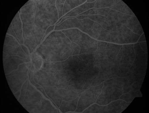 Branch Retinal Arterial Occlusion 20/20 Vision - Symptoms for 1 Day
75-year-old man was seen in the office on 4/6/2010.  He noticed a sudden vision change in the right eye yesterday morning.  20/20 Vision both Eyes

