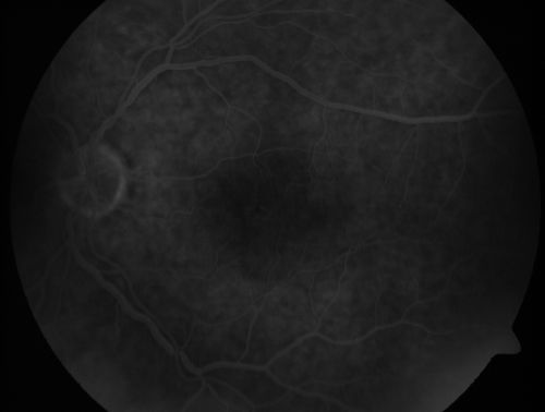 Branch Retinal Arterial Occlusion 20/20 Vision - Symptoms for 1 Day
75-year-old man was seen in the office on 4/6/2010.  He noticed a sudden vision change in the right eye yesterday morning.  20/20 Vision both Eyes

