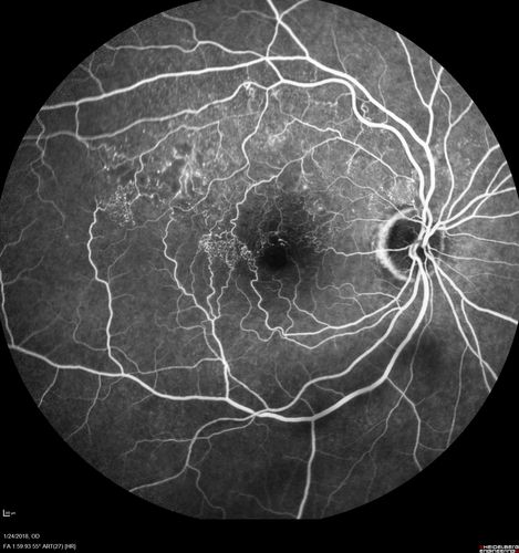 Vascular Remodeling Bilateral BRVO
85 year old female 20/25 OU with BRVO 7 years ago in both eyes.  She has a change in vision.  The FA shows extensive collaterallization and vascular remodeling in each macula.
