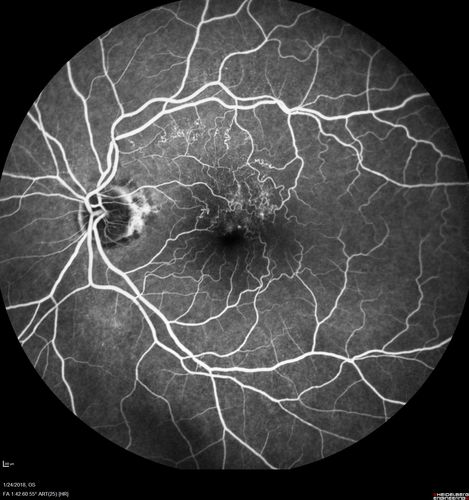 Vascular Remodeling Bilateral BRVO
85 year old female 20/25 OU with BRVO 7 years ago in both eyes.  She has a change in vision.  The FA shows extensive collaterallization and vascular remodeling in each macula.
