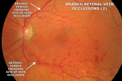 Macular Branch Retinal Vein Occlusions (2) Left Eye - No Macular Edema (yet) 
77-year-old woman with two macular branch retinal vein occlusions in the left eye  OD 20/25
