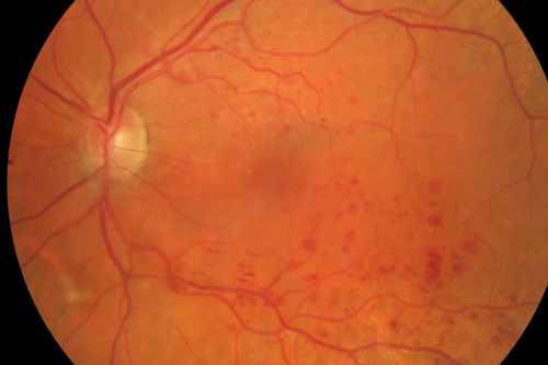 Macular Branch Retinal Vein Occlusions (2) Left Eye - No Macular Edema (yet) 
77-year-old woman with two macular branch retinal vein occlusions in the left eye  OD 20/25
