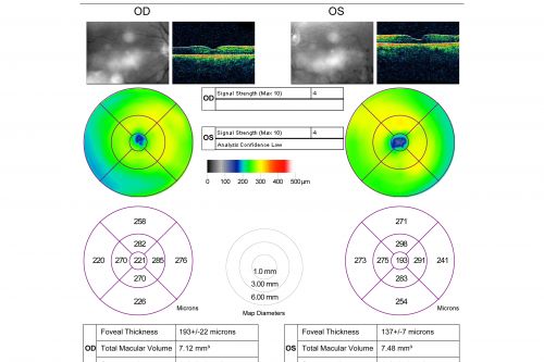 Macular Branch Retinal Vein Occlusions (2) Left Eye - No Macular Edema (yet) 
77-year-old woman with two macular branch retinal vein occlusions in the left eye  OD 20/25
