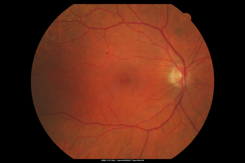 Macular Branch Retinal Vein Occlusions (2) Left Eye - No Macular Edema (yet) 
77-year-old woman with two macular branch retinal vein occlusions in the left eye  OD 20/25
