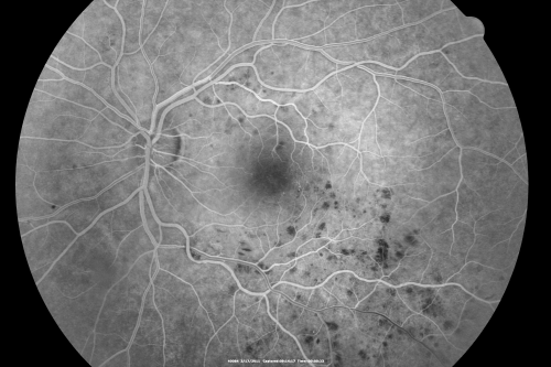 Macular Branch Retinal Vein Occlusions (2) Left Eye - No Macular Edema (yet) 
77-year-old woman with two macular branch retinal vein occlusions in the left eye  OD 20/25
