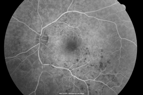 Macular Branch Retinal Vein Occlusions (2) Left Eye - No Macular Edema (yet) 
77-year-old woman with two macular branch retinal vein occlusions in the left eye  OD 20/25
