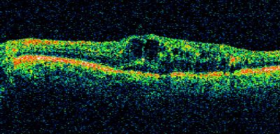 brvo cme with small serous macular detachment 
70 year old woman with 20/80 vision from a branch retinal vein occlusion and macular edema.  She has had laser treatment and intravitreal steroids.  Her vision with further laser improved to 20/50.
Võtmesõnad: branch retinal vein occlusion; macular edema; collateral vessels; exudate