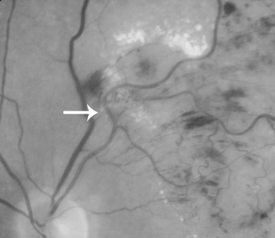BRVO arrow showing obstruction point with collateral vessels - red free photo
70 year old woman with 20/80 vision from a branch retinal vein occlusion and macular edema.  She has had laser treatment and intravitreal steroids.  Her vision with further laser improved to 20/50.
Keywords: branch retinal vein occlusion; macular edema; collateral vessels; exudate