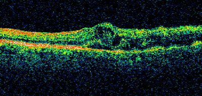 branch retinal vein occlusion - oct line scan
70 year old woman with 20/80 vision from a branch retinal vein occlusion and macular edema.  She has had laser treatment and intravitreal steroids.  Her vision with further laser improved to 20/50.
Keywords: branch retinal vein occlusion; macular edema; collateral vessels; exudate