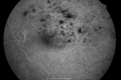 branch retinal vein occlusion - fluorescein angiogram
70 year old woman with 20/80 vision from a branch retinal vein occlusion and macular edema.  She has had laser treatment and intravitreal steroids.  Her vision with further laser improved to 20/50.
Keywords: branch retinal vein occlusion; macular edema; collateral vessels; exudate