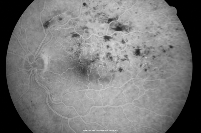 branch retinal vein occlusion - fluorescein angiogram
70 year old woman with 20/80 vision from a branch retinal vein occlusion and macular edema.  She has had laser treatment and intravitreal steroids.  Her vision with further laser improved to 20/50.
Keywords: branch retinal vein occlusion; macular edema; collateral vessels; exudate