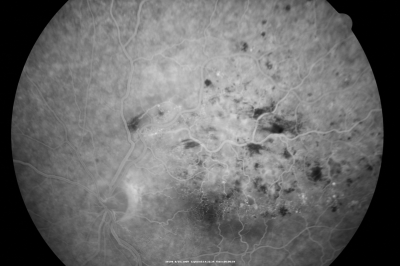branch retinal vein occlusion - fluorescein angiogram
70 year old woman with 20/80 vision from a branch retinal vein occlusion and macular edema.  She has had laser treatment and intravitreal steroids.  Her vision with further laser improved to 20/50.
Keywords: branch retinal vein occlusion; macular edema; collateral vessels; exudate