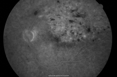 branch retinal vein occlusion - fluorescein angiogram
70 year old woman with 20/80 vision from a branch retinal vein occlusion and macular edema.  She has had laser treatment and intravitreal steroids.  Her vision with further laser improved to 20/50.
Mots-clés: branch retinal vein occlusion; macular edema; collateral vessels; exudate