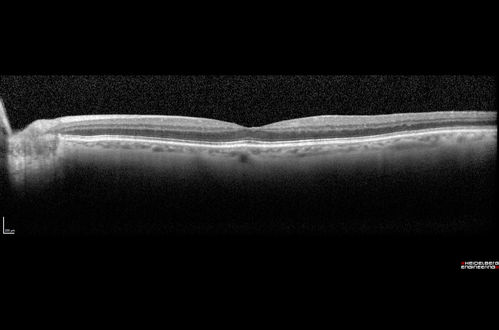 Branch Retinal Vein Occlusion (BRVO) no macular edema - cotton wool spot
85 year old man with asymptomatic BRVO - his vision stayed great without needing any treatment.
