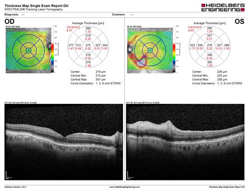 Branch Retinal Vein Occlusion (BRVO) no macular edema - cotton wool spot
85 year old man with asymptomatic BRVO - his vision stayed great without needing any treatment.
