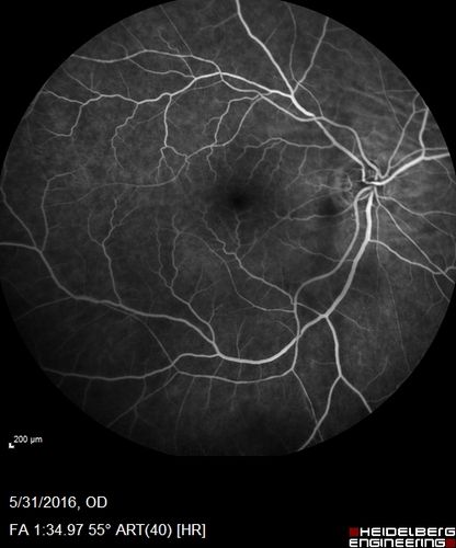 Branch Retinal Vein Occlusion (BRVO) no macular edema - cotton wool spot
85 year old man with asymptomatic BRVO - his vision stayed great without needing any treatment.
