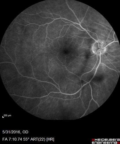 Branch Retinal Vein Occlusion (BRVO) no macular edema - cotton wool spot
85 year old man with asymptomatic BRVO - his vision stayed great without needing any treatment.

