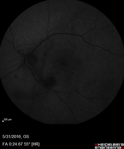 Branch Retinal Vein Occlusion (BRVO) no macular edema - cotton wool spot
85 year old man with asymptomatic BRVO - his vision stayed great without needing any treatment.
