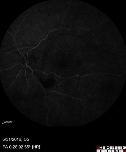 Branch Retinal Vein Occlusion (BRVO) no macular edema - cotton wool spot
85 year old man with asymptomatic BRVO - his vision stayed great without needing any treatment.
