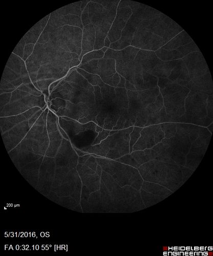 Branch Retinal Vein Occlusion (BRVO) no macular edema - cotton wool spot
85 year old man with asymptomatic BRVO - his vision stayed great without needing any treatment.
