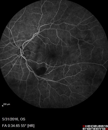 Branch Retinal Vein Occlusion (BRVO) no macular edema - cotton wool spot
85 year old man with asymptomatic BRVO - his vision stayed great without needing any treatment.
