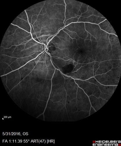Branch Retinal Vein Occlusion (BRVO) no macular edema - cotton wool spot
85 year old man with asymptomatic BRVO - his vision stayed great without needing any treatment.
