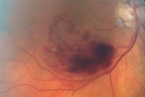 Branch Retinal Vein Occlusion with worse macular edema from hypertension - Photo from 2008 with initial occlusion - Vision 20/40
